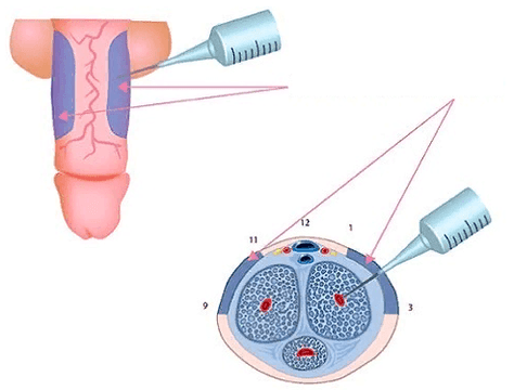Inxeccións por engrosamento do pene